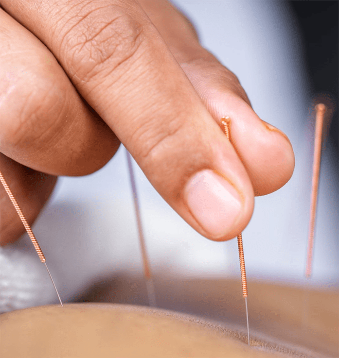 acupuncture needles