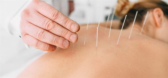 acupuncture for weight loss